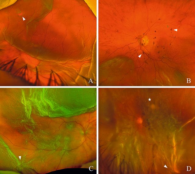 PVR in verschiedenen Ausprägungen