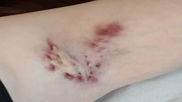 Abbildung Acne inversa bzw. Hidradenitis Suppurativa (HS), eine chronisch entzündliche Hauterkrankung.