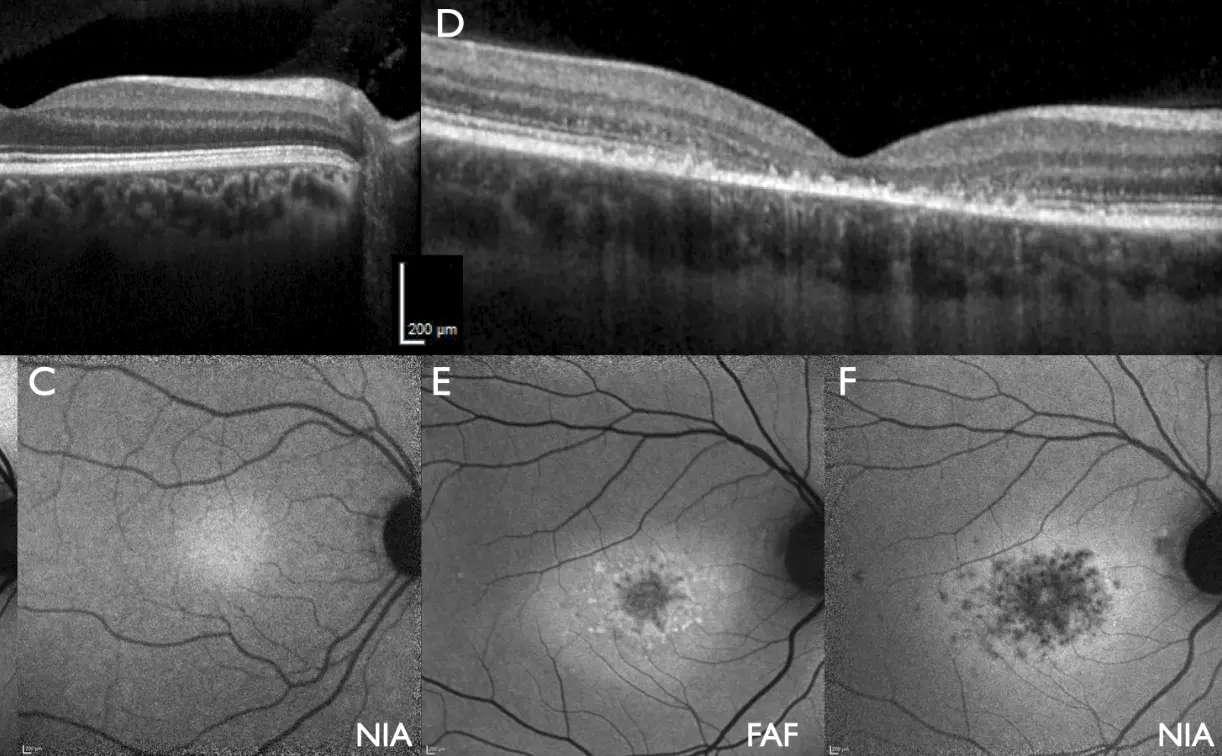 OCT Aufnahmen eines Auges mit Stargardt-Krankheit
